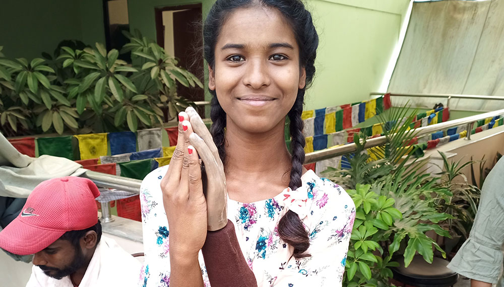girl with prosthetic hand provided by TeamBonding